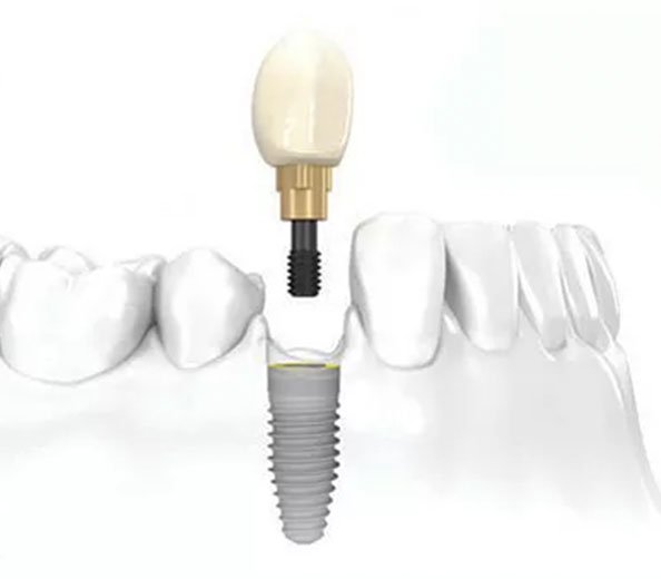 Implant Crowns