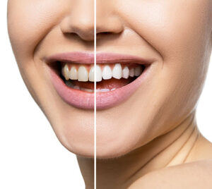 Teeth before and after care, therapy and whitening.