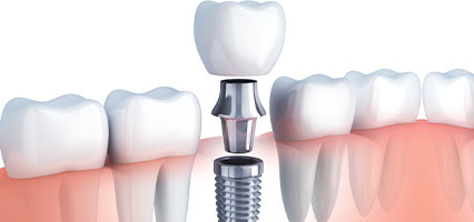 Dental Implant diagram