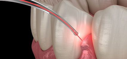 laser dentistry